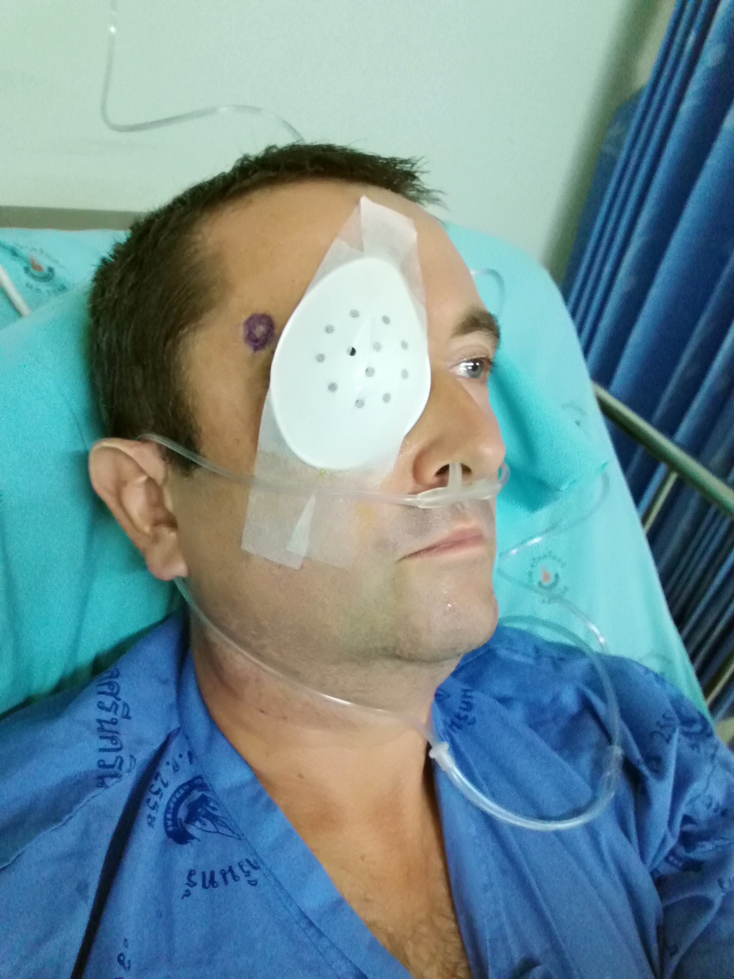 Steven Howard in a Thai hospital a few hours prior to the operation to have his right eye removed. They blue mark is there to ensure the surgeon does not make a mistake and remove the wrong eye!